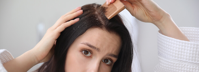 dermatitis seborreica cuero cabelludo